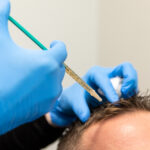 PRP hair restoration treatment
