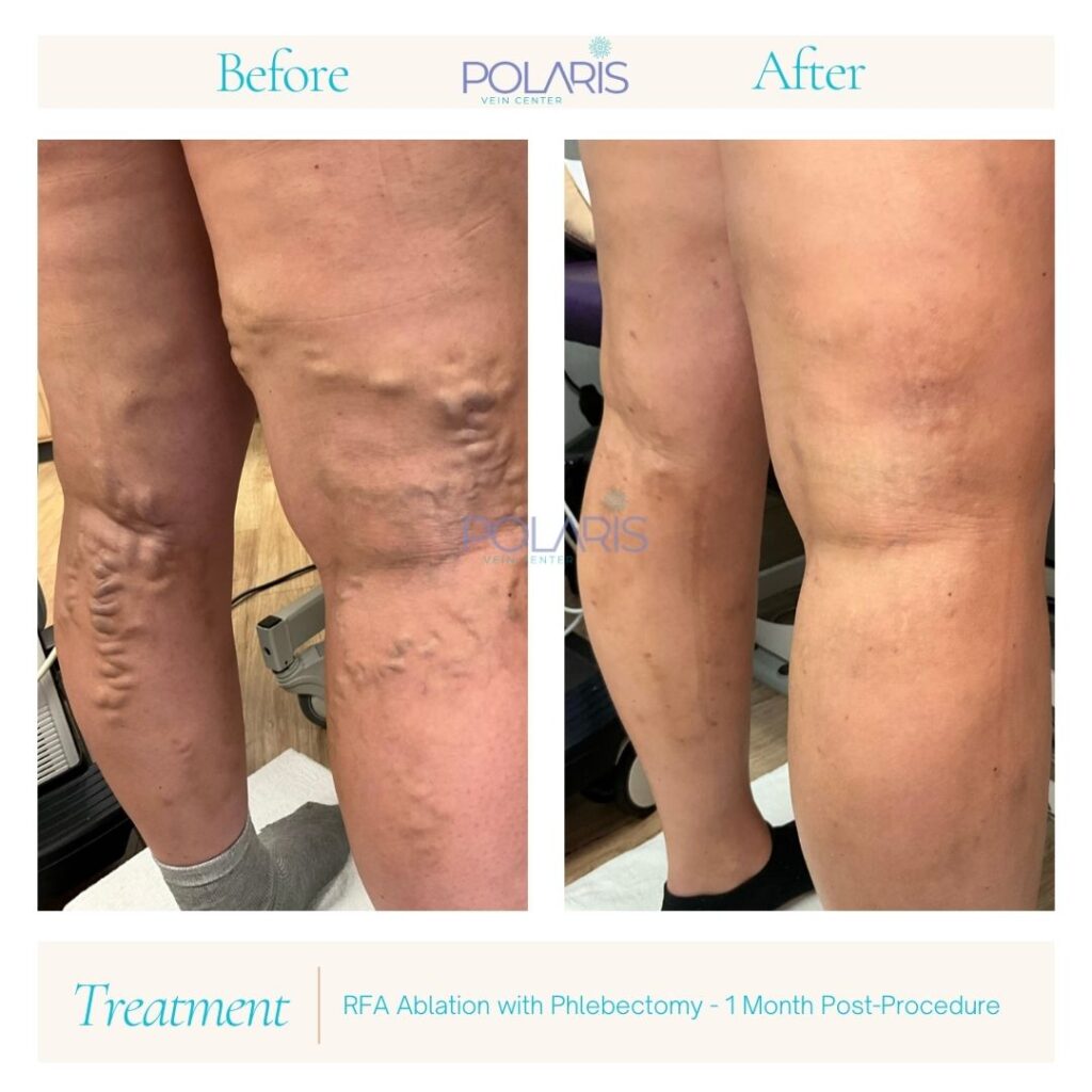 A side by side comparison of the look of vericose veins before trying vein ablation near Upper Arlington, OH, and 1 month after the treatment. 