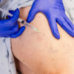 A close-up of a provider's gloves performing sclerotherapy near New Albany, OH