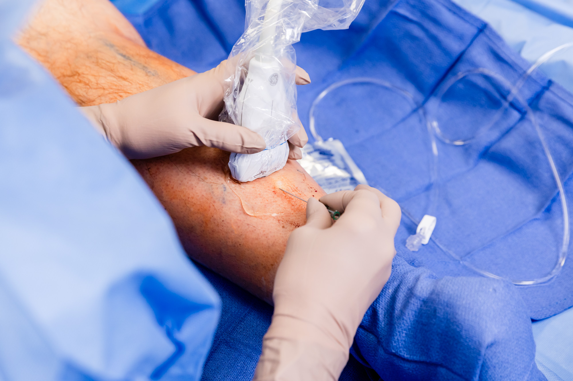 A surgeon performing Vein Therapy near New Albany, OH