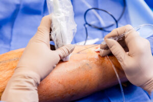 A close-up of a provider's hand as they perform a varicose vein treatment near New Albany, OH.
