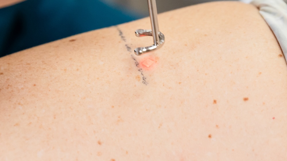 Laser placed on tattoo to remove from body and promote skin care in Columbus, OH